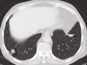 – Thoracic CT scan after treatment: resolving nodules in a follow-up CT scan 8 months later.
