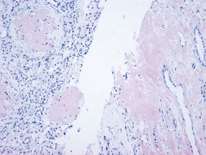 Renal biopsy (mother). Massive glomerular deposit in cortex (left) and interstitial deposit in bone marrow (right) (Congo red ×100).