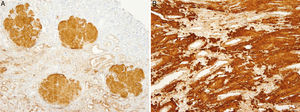(A) Renal biopsy (mother). Immunohistochemistry for positive Apo AI in glomerular deposits. (B) Renal biopsy (mother). Immunohistochemistry for positive Apo AI in renal medulla interstitial deposits.