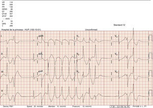 Polymorphic ventricular tachycardia. Increased QT.