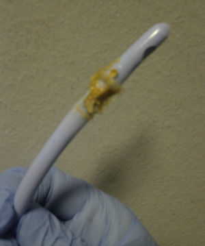 Appearance of obstructed urinary catheter.