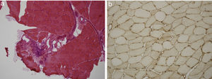 (a) Haematoxylin–eosin study of skeletal muscle tissue with mononuclear inflammatory infiltrate with preferential perimysial localisation. (b) Immunohistochemical study of muscle tissue for MHC 1 (HLA) showing its overexpression in the membrane of muscle fibres.