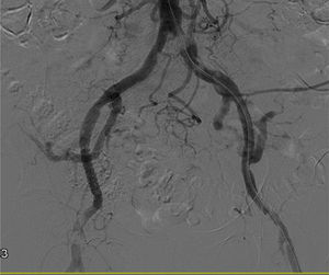 Obliteration of the distal portion of the left common iliac artery.