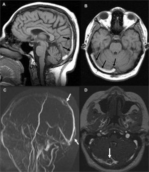 Cranial MR on admission; superior sagittal sinus (A) and right transverse sinus (B) thrombosis (arrows). Follow-up MR angiography (C, D); sinuses are partially recanalized with persistant hypointense thrombotic filling defects (arrows).
