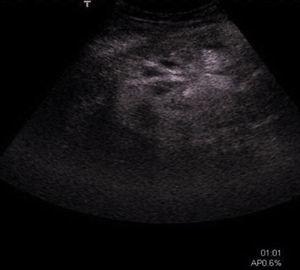 Ultrasound with contrast of transplanted kidney after RFA treatment of renal tumour. It shows absence of enhancement, indicating tumour destruction.