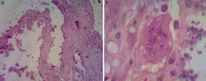 Histological sections of the lesions in the right buttock and thigh, in a 23-year-old patient. (a) Areas with a cystic appearance with calcium deposits and epithelioid cells. (b) Presence of multinucleate giant cells.