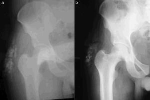 Comparative radiographic imaging of a patient with TC after 7 years of acetazolamide treatment: (a) Start of treatment (August 2008). (b) Follow-up (February 2015).