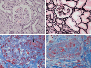Renal histopathological lesions from haemolytic uraemic syndrome. (A) Ischaemic and retracted glomeruli. (B) Mesangiolysis (C) Thrombi in the glomerular capillaries (arrow). (D) Artery occluded by platelet thrombi. Photographs courtesy of Dr. R. Ortega (Histopathology department of the Hospital Universitario Reina Sofía, Córdoba).