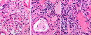 Glomeruli with mesangial hypercellularity and interstitial expansion by inflammatory cells and eosinophils. Severe tubulointerstitial inflammation and tubulitis.