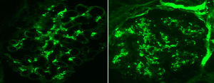 Immunofluorescence in conjugated antibodies showing diffuse granular mesangial uptake for C3 and IgA.