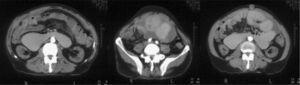 CT scan: thickened peritoneum associated with pelvic fluid collection with septa inside and air-fluid levels.