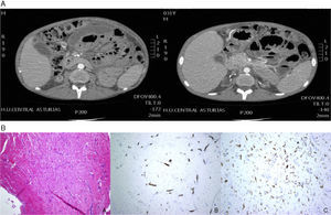 (A) CT scan: gastric and duodenal dilatation, with abundant intra-abdominal loculated fluid, and shift of small intestine loops. (B) Peritoneal biopsy; haematoxylin and eosin staining, and immunohistochemistry techniques.