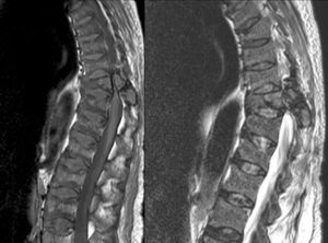 Thoracolumbar MRI: sagittal plane of MRI in T1 and T2 of the thoracolumbar spine showing a focal lesion in the left posterior elements of the D10 vertebra involving the pedicle, pars, and lamina. The lesion has an expansive character and is surrounded by a thin, newly-formed shell of periosteal bone with a maximum diameter of 3.7cm, presenting soft tissue components and invading the spinal canal, resulting in clear cord compression with narrowing. An intermediate signal is observed in all pulse sequences and we believe it is consistent with a brown tumour (osteoclastoma).1,2