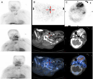 Parathyroid scintigraphy: (A) Planar imaging of head and chest in the anterior projection following administration of 20mCi of 99mTc-MIBI (methoxy isobutyl isonitrile) at 20, 60, and 180min, showing increased uptake of the radiotracer next to the lower half of the left thyroid lobe, which was sustained during the long period of examination. (B) Selected axial section of the SPECT/CT image at 60min, SPECT/CT fusion showing a focus of increased uptake of retrotracheal location somewhat to the left, up to D1. Findings are consistent with parathyroid adenoma or hyperplasia. (C) Selected axial section of the SPECT-CT image, based on skull and jaw region. The SPECT, CT, and fusion images show a large area of irregular increased uptake of radiotracer in left maxilla, appearing as expansive osteolytic lesion in the CT scan and consistent with a brown tumour.3