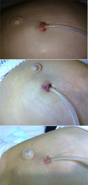 Top: erythema in the peritoneal dialysis catheter exit site, with granuloma and chocolate-like discharge. Centre: appearance of the exit site at Week 2. Bottom: appearance of the exit site at Week 6 from the start of targeted therapy.