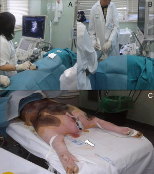 Live animal model. (A) Two students visualizing the appropriate puncture point in the kidney. (B) Taking a biopsy in the animal. (C) Macroscopic haematuria after renal biopsy in the animal (arrow).