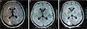 Cranial MRI findings: (A) bilateral parieto-occipital subcortical white matter hyperintensity; (B) follow-up MRI after 10 days of treatment, with complete resolution of lesions; (C) MRI confirming recurrent RPLS, 6 months after the first episode.