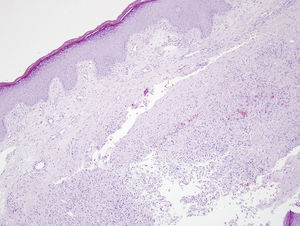 Skin biopsy. Extensive areas of necrosis can be seen in the dermis.