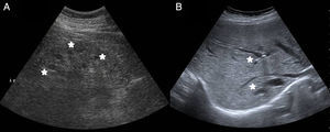 Ultrasound (A) Cortical kidney sinus cysts. (B) Cystic dilation of the intrahepatic bile ducts.