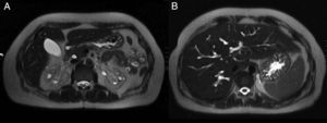 Magnetic resonance cholangiopancreatography: (A) Bilateral kidney cysts. (B) Caroli's disease in the liver.