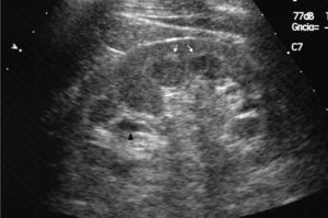 Abdominal ultrasound, in a longitudinal oblique view of the left kidney, showing corticomedullary hyperechogenicity (white arrows) and parapelvic cysts (black arrows).