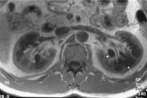 Axial T1 MRI, showing kidneys with poor corticomedullary differentiation (arrows) and parapelvic cysts (short arrow).