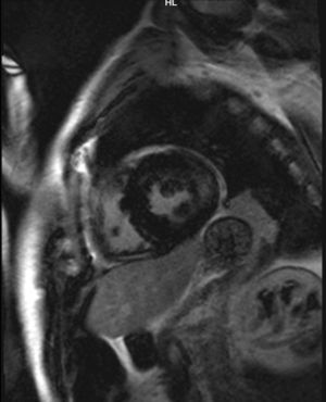 Cardiac MRI showing diffuse thickening of both ventricles, with lateral midwall enhancement extending to the apex of the left ventricle, consistent with Fabry disease.