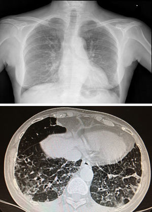 Chest X-ray and CT scan. Distortion of the pulmonary interstitium on the subpleural level of both bases, with thickening of the intralobular interstitium and interlobular septa, consistent with pulmonary fibrosis predominately on the posterior–basal subpleural level. Also bilateral basal cylindrical bronchiectasis.