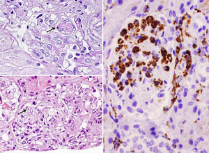 Renal biopsy. Glomeruli with mesangial and endocapillary proliferation in which some hyaline pseudothrombi of different sizes are observed (arrows). (A) Periodic acid–Schiff (PAS) 60×. (B) Haematoxylin and eosin 40×. (C) Presence of numerous intraglomerular macrophages. Immunohistochemistry for CD68 40×.