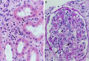 Acute humoral rejection. (A) Capillaritis. Presence of inflammatory cells (polynuclear leukocytes) in peritubular capillaries (H&E). (B) Glomerulitis. Presence of inflammatory cells (macrophages) in glomerular capillaries (PAS).