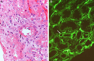 (A) Acute humoral rejection. Transmural arteritis (fibrinoid necrosis of the vascular wall) (H&E). (B) C4d deposits in the peritubular capillaries (Immunofluorescence).