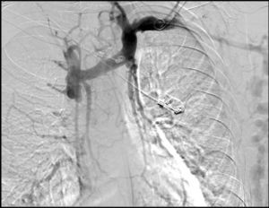 Venogram image that shows cava thrombosis and significant collateral circulation through the azygos system.