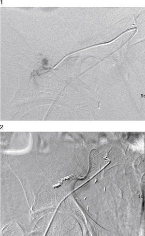 Arteriogram of the renal graft with contrast extravasation in a distal branch. Selective embolisation of a distal branch of the artery of the graft with resolution of the extravasation.