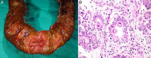 (A) Intra-operative image of the resected specimen. An opening has been made in the resected loop of small intestine and the ulceration that is the source of the bleeding may be observed. B) Histology image with H&E 400×. Cytomegalic inclusions (arrows) in the interior of the mucus-depleted intestinal cells.