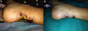Healing of calciphylaxis lesions after parathyroidectomy. At the beginning (A) and after 2 months (B) of treatment with ST.