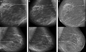 Right (above) and left (below) mammograms in 2011 (A), in 2013 (B) and in 2015 (C).