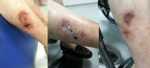 Right leg: left: before treatment; centre: after intravenous treatment; right: after topical treatment.