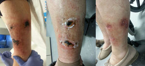 Left leg: left: before treatment; centre: after intravenous treatment; right: after topical treatment.