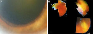 (A) Inflammatory reaction in the anterior chamber with thin retrokeratic precipitate, also discrete ciliary injection and a dense grade 5 cataract, LOCS II. (B) Funduscopy: moderate vitritis, optic nerve swelling and white-yellowish lesions in the upper and lower temporal nasal retina.
