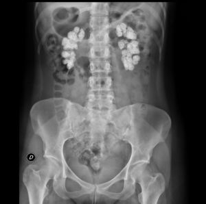 Plain abdominal X-ray with extensive bilateral renal calcifications.