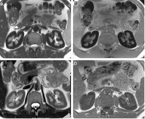(A) Axial T2 sequence image. Diffuse low signal of the renal cortex compared to the liver and skeletal muscle. (B) Axial T1 in-phase sequence also shows low signal of the renal cortex compared to the liver and skeletal muscle. (C) MR of the same patient 14 months after start of treatment. Axial T2 sequence image shows important improvement of the low signal on T2. (D) Axial T1 in-phase sequence confirms the important increase of the renal cortex signal compared with the previous MR study.
