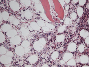 Image of bone marrow showing immature erythroid cells with signs of parvovirus B19 infection (haematoxylin and eosin; 100x).