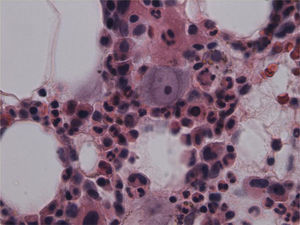 Image of bone marrow showing proerythroblast with nuclear viral inclusion characteristic of parvovirus B19 infection (haematoxylin and eosin; 400x).