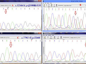 Chromatogram (Chromas software version 2.4.1) for the region containing some novel mutations. Red arrow shows the substituted nucleotide. Sequence analysis of PCR products from the promoter region and all exons was performed. Both strands were sequenced using the Big Dye Termination system in an ABI 310 capillary sequencer (Macrogen, South Korea). A, shows a single base pair deletion in nucleic acid position 323 (c.323delA) in exon 6, leading to premature truncation of the protein p.Q108RfsX10 which was observed in three patients (11%) in homozygous state. B, c.661insT; p.V221CfsX6 is a novel homozygous single base pair deletion in exon 9 observed in one patient. C, the variant c.779C>T; p.T260I (in exon 10) was detected in 18 of 28 (64%) patients. D, c.261T>A; p.F87L in exon 6 of CTNS is the most common mutation in our population which was observed in six patients (21.4%) in heterozygote and homozygote states.
