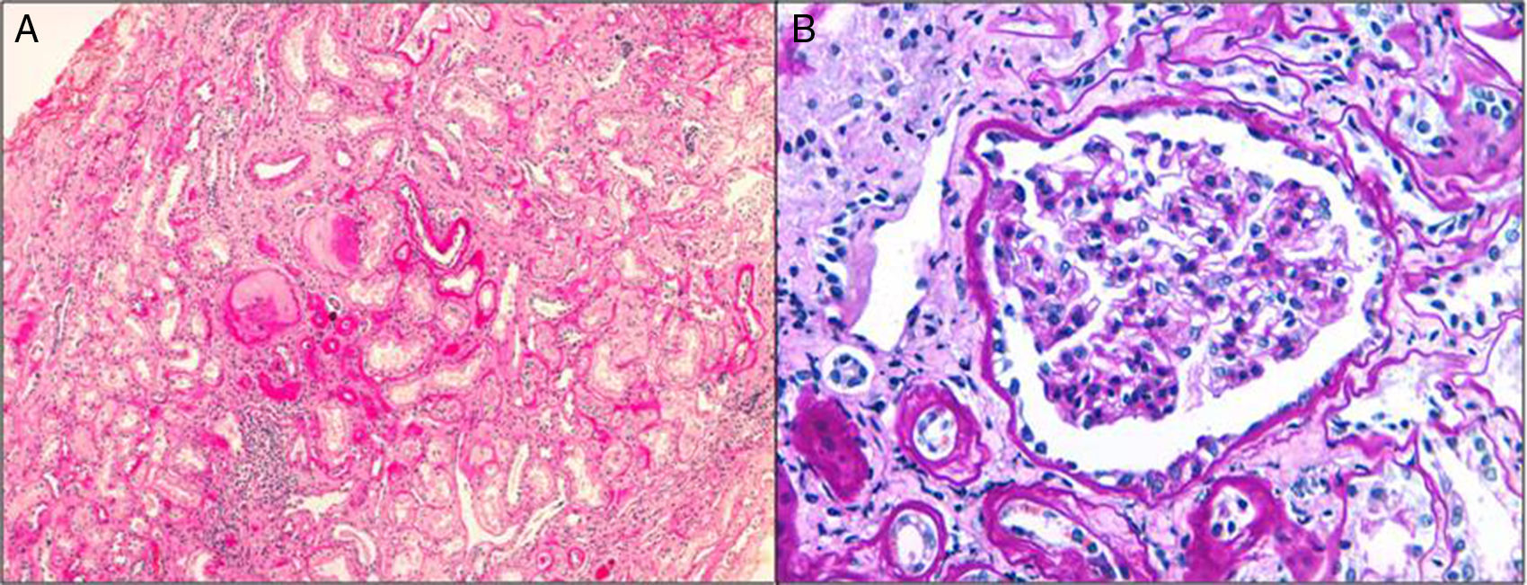 A review on autosomal dominant tubulointerstitial kidney disease ...