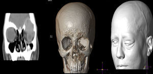 Cranial and orbital CT with pre-surgery reconstruction.