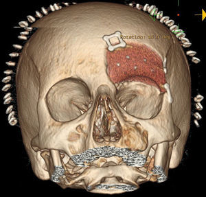 Cranial and orbital CT with post-surgery reconstruction.