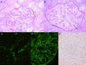 Renal biopsy. PAS 60×: mesangial proliferation (A), prominent podocytes (B, arrow). IF: diffuse and global mesangial IgM (C), C1q mesangial segmental (D). In situ hybridization for negative EBV (E).