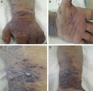 Multiple discrete, (nonulcerated, erythamatous-violaceous noduler and plaques on left forearm and hand(A,B,C,D).
