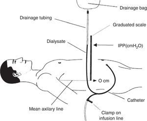 Scheme of intraperitoneal pressure measurement (IPP) using a ruler and the drain line of a PD bag with Y system. Source: Mathieu et al.,7 with permission.